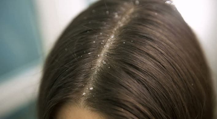 sampo untuk rambut berketombe (1)