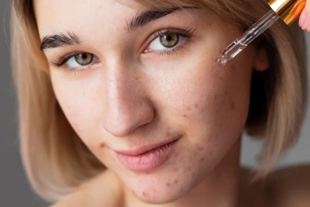 skincare untuk menghilangkan bekas jerawat