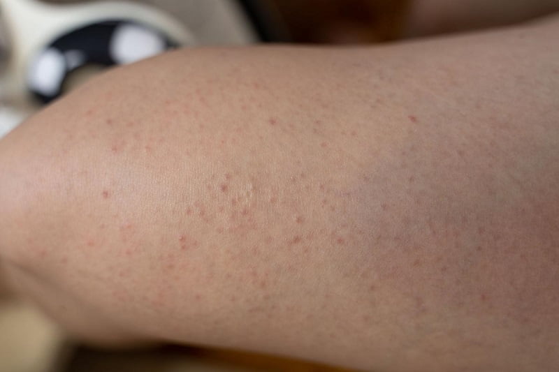 apa itu strawberry skin atau legs