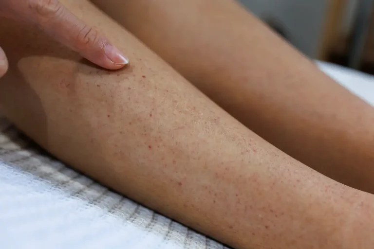 6 Cara Mengatasi Strawberry Skin pada Kaki agar Kembali Halus