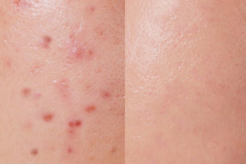 penyebab jerawat di pantat