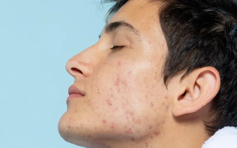 skincare untuk mengatasi melasma