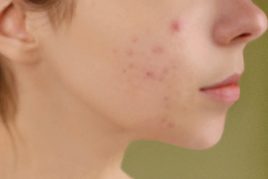 kandungan skincare yang menyebabkan purging