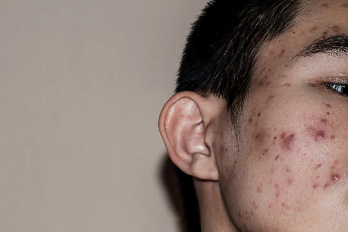 cara menghilangkan ice pick scar