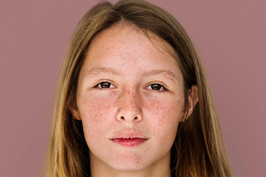 apakah bopeng bisa hilang dengan skincare